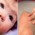 Hand, foot and mouth disease and folk tips to cure hand, foot and mouth disease quickly p5mvnu3bba7se.jpg